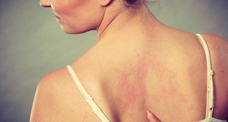 Σχεδόν οι μισοί Ευρωπαίοι έχουν τουλάχιστον ένα δερματολογικό πρόβλημα