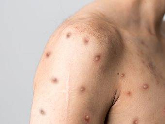 Φιλανδία: Πιθανό κρούσμα της ευλογιάς των πιθήκων στο Ελσίνκι.