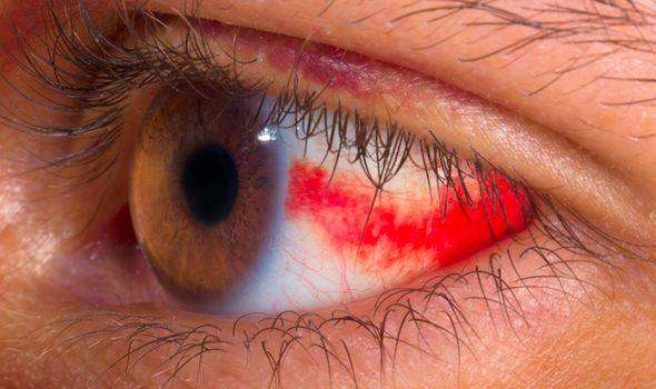 Υψηλή πίεση στα μάτια: Τι πρέπει να προσέξουμε