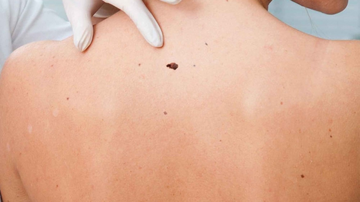 Ευρώπη: Αυξήθηκε δραματικά ο καρκίνος του δέρματος στον ενήλικο πληθυσμό