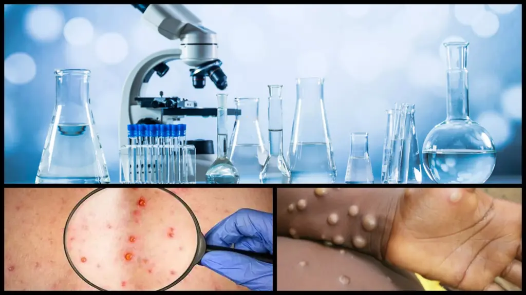 Πορτογαλία: Τα 119 έφτασαν τα κρούσματα ευλογιάς των πιθήκων