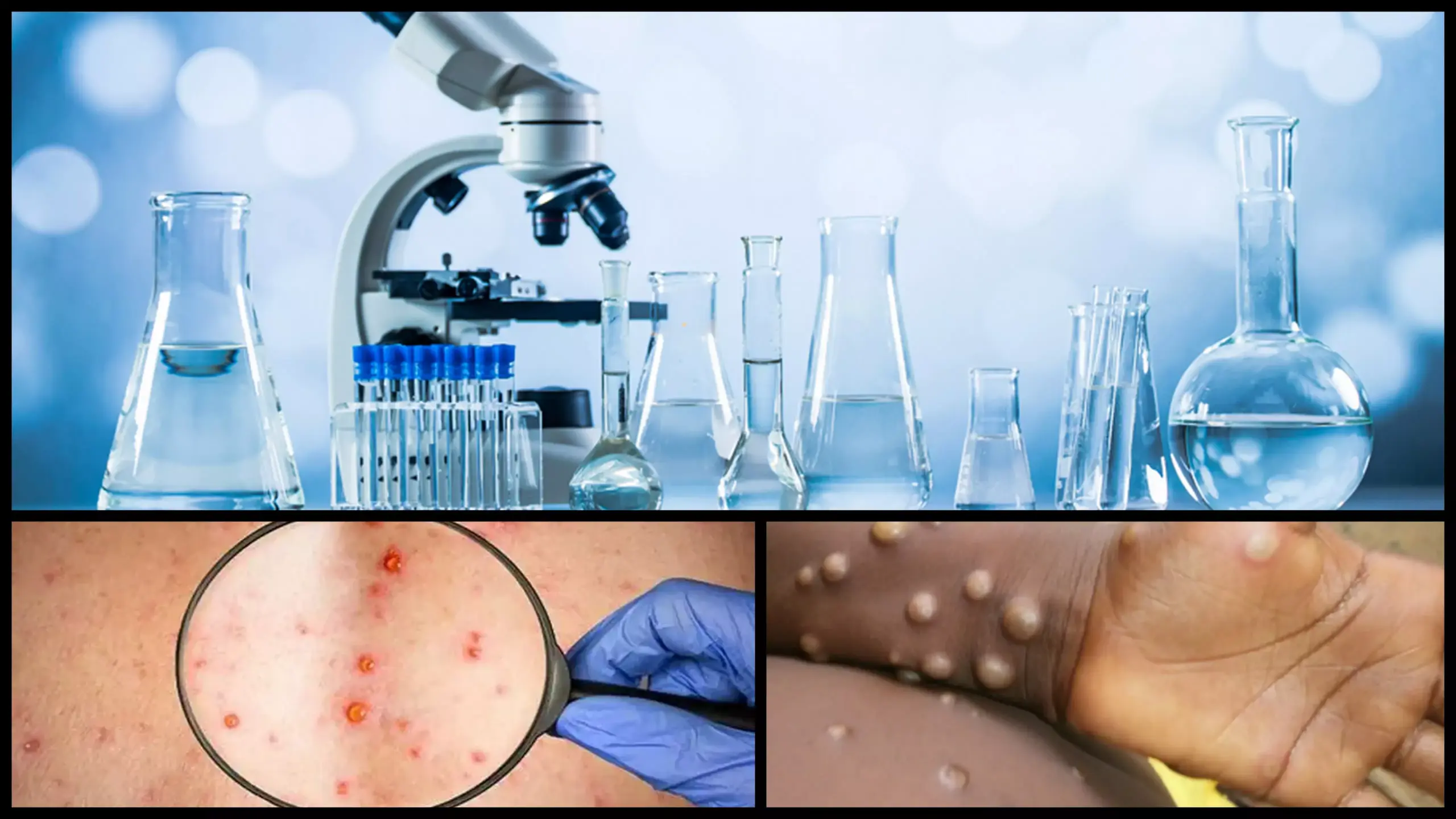 Πορτογαλία: Τα 119 έφτασαν τα κρούσματα ευλογιάς των πιθήκων