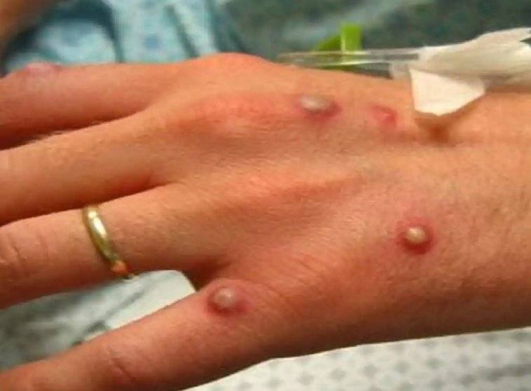 Και τρίτο κρούσμα ευλογιάς των πιθήκων στην Ελλάδα