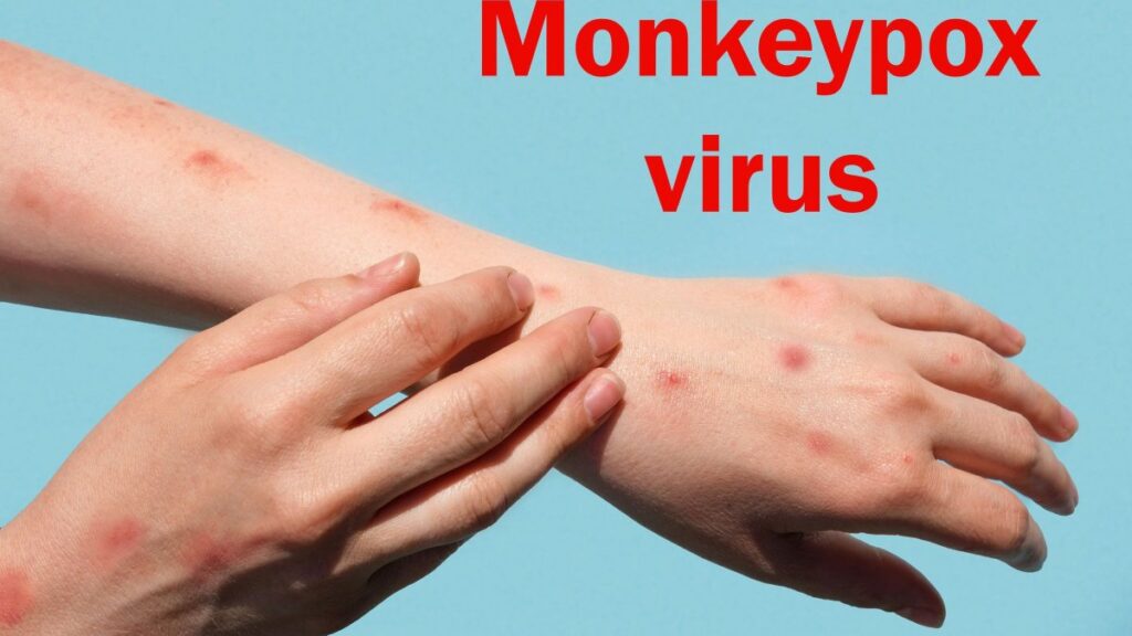 Ευλογιά των πιθήκων: Σε 20 ανέβηκαν τα κρούσματα στην Ελλάδα, όλοι άντρες.