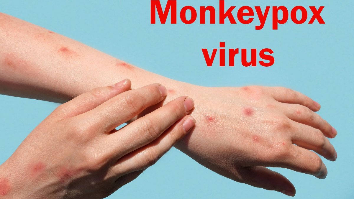 Ευλογιά των πιθήκων: Σε 20 ανέβηκαν τα κρούσματα στην Ελλάδα, όλοι άντρες.