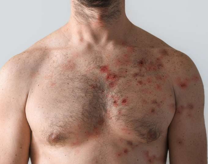 Λος Άντζελες: Πρώτος θάνατος από την ευλογιά των πιθήκων, δεύτερος για τις ΗΠΑ