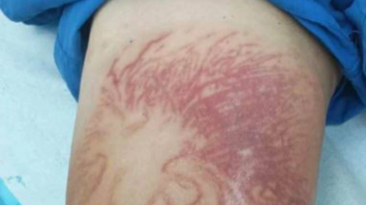 Κόρινθος: Στο νοσοκομείο 9χρονος, τον τσίμπησε θαλάσσια ανεμώνη