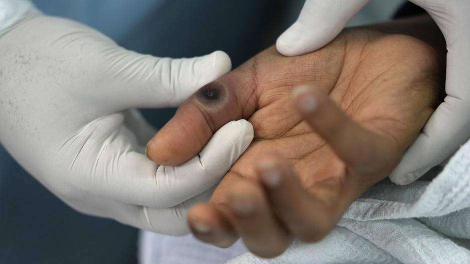 Ευλογιά των πιθήκων: Στη Σουηδία το πρώτο ευρωπαϊκό κρούσμα του νέου στελέχους