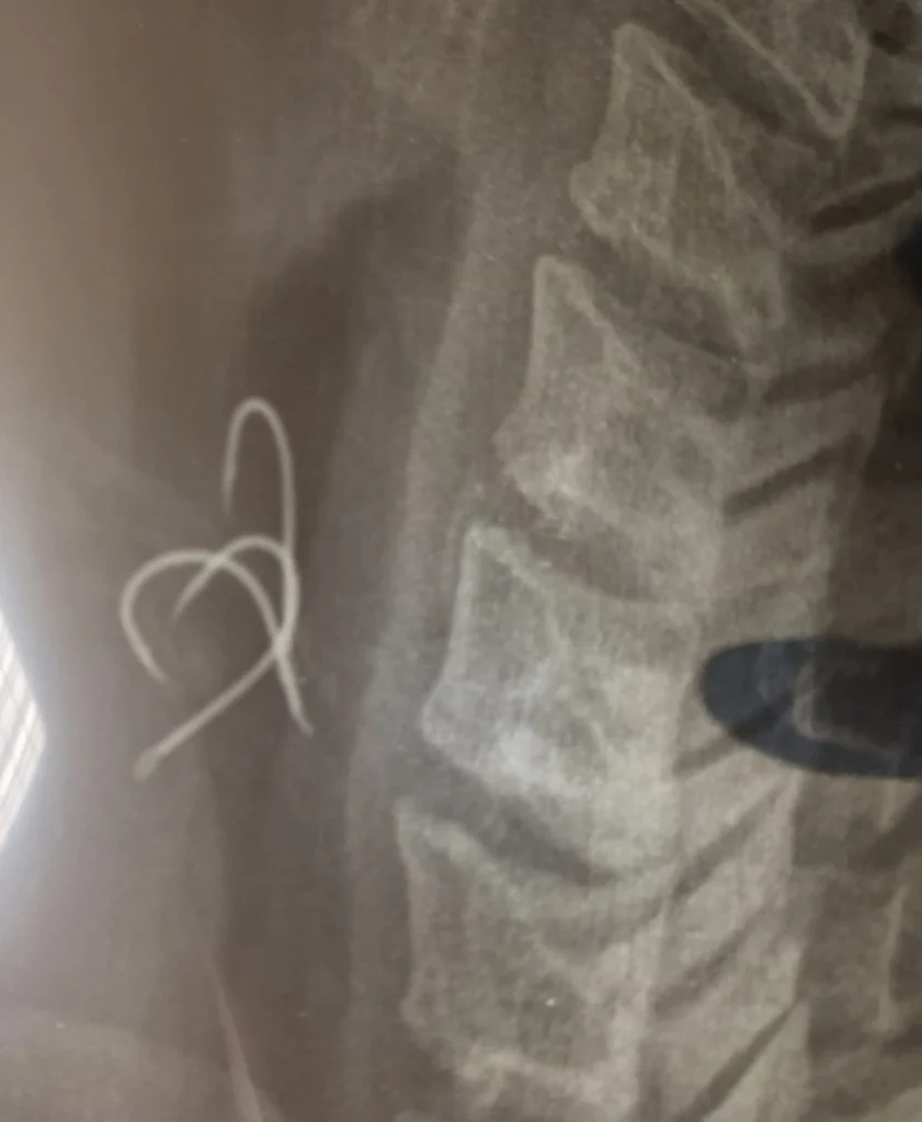 Στο νοσοκομείο 38χρονος – Κατάπιε αγκίστρι που ήταν μέσα σε χταπόδι