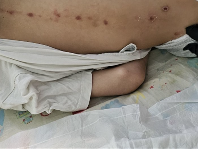 Στο Καραμανδάνειο μεταφέρθηκε 10χρονο με ύποπτα σημάδια στην πλάτη του – Εγκαύματα τριβής ή κακοποίηση;